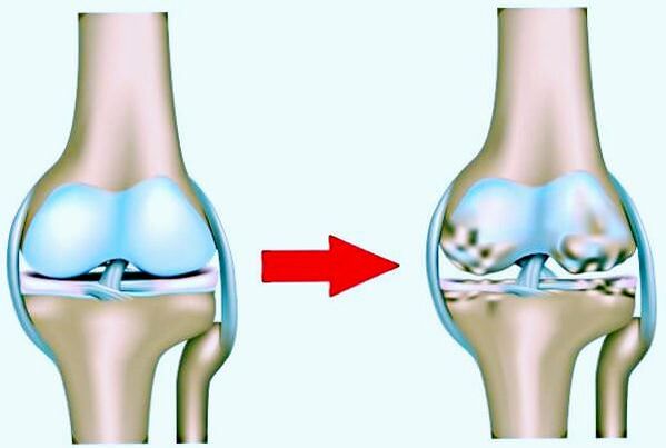 Normales Kniegelenk und durch Arthrose getroffen
