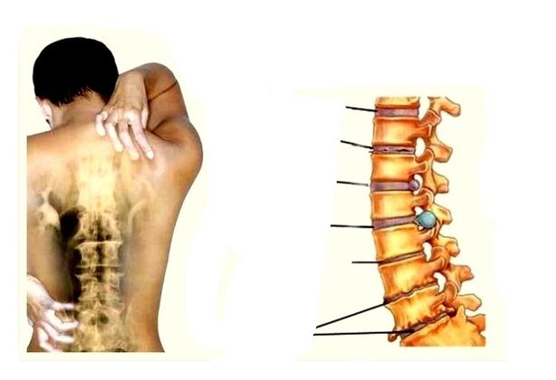 Entwicklungsphase der Osteochondose