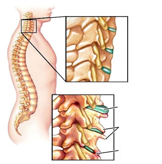 Sana- und osteochende Wirbelsäule beschädigt