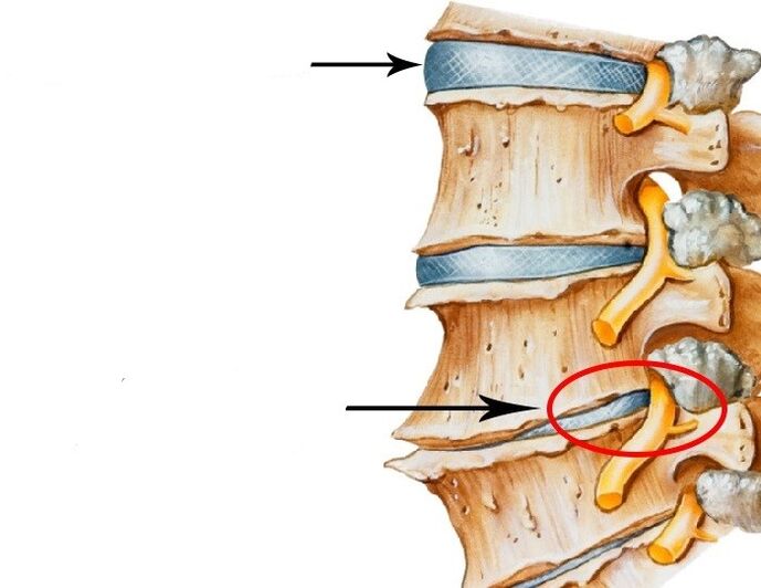 beschädigte Scheibe und verletzte gegen den Nerv mit zervikaler Osteochondose