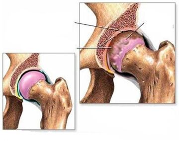 Arthrose des Hüftgelenks