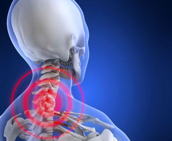 Osteochondrose der Halswirbelsäule